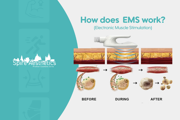 EMS treatment for post pregnancy weight loss treatment Rhyl