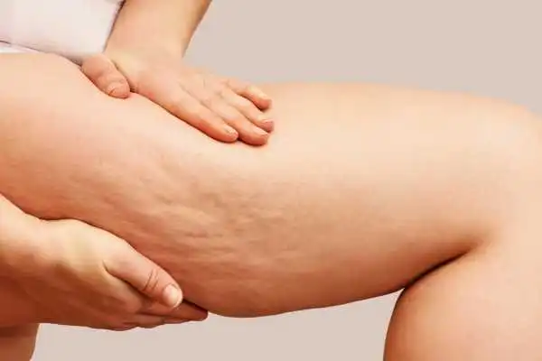 Image of woman showing leg with cellulite Rhyl