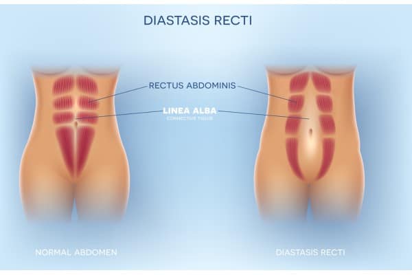 What Non-Surgical Options Are Available for Diastasis Recti Rhyl?