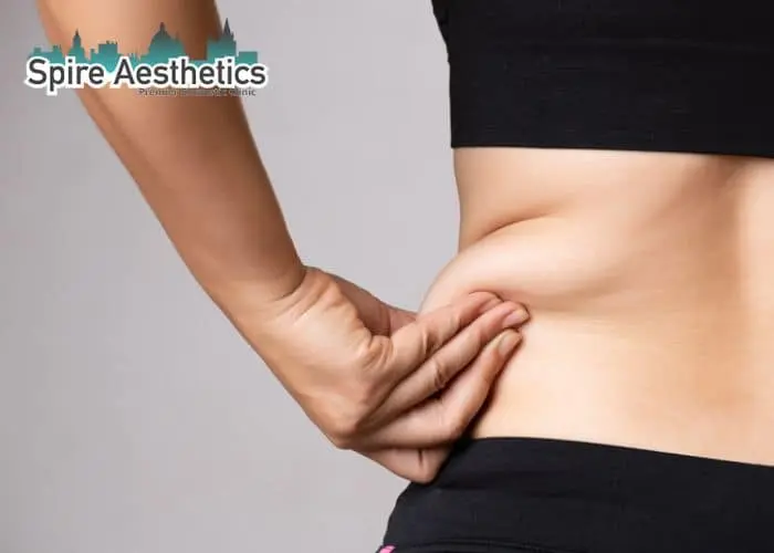 Image of woman pinching fat on their hips Rhyl. Fat Freezing treatment
