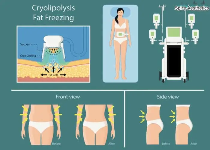 Fat freezing treatment Rhyl benefits for competitions to remove stubborn fat deposits.