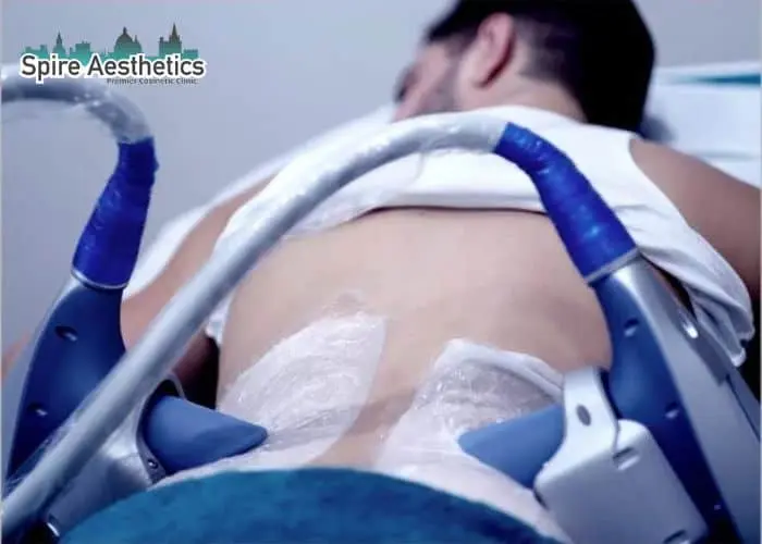 Man having fat freezing treatment done on love handles before a competitions Rhyl to create a sculpted look.