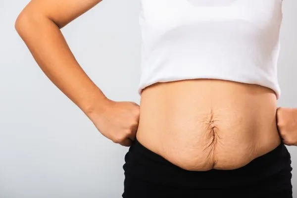Image of a woman's stomach after weight loss with sagging skin following a gastric band Rhyl