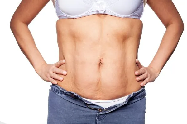 sagging skin on woman's stomach after weight loss injections Rhyl