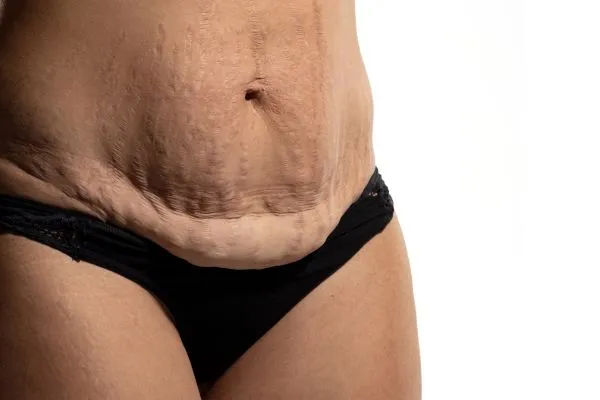 Image of womans stomach after weight loss injections Rhyl showing saggy skin