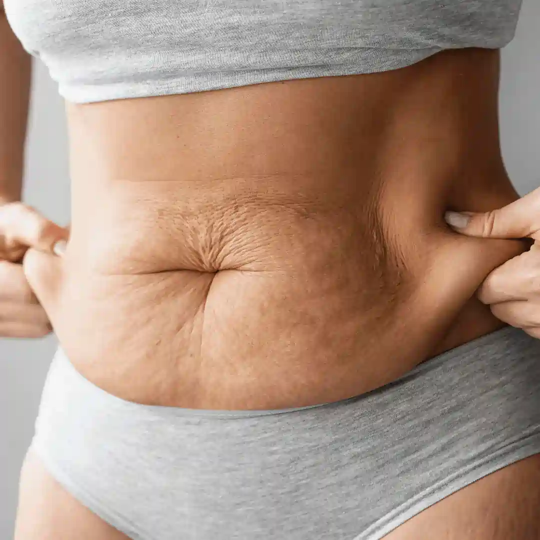 Is It Normal to Have Loose Skin After Pregnancy Rhyl?