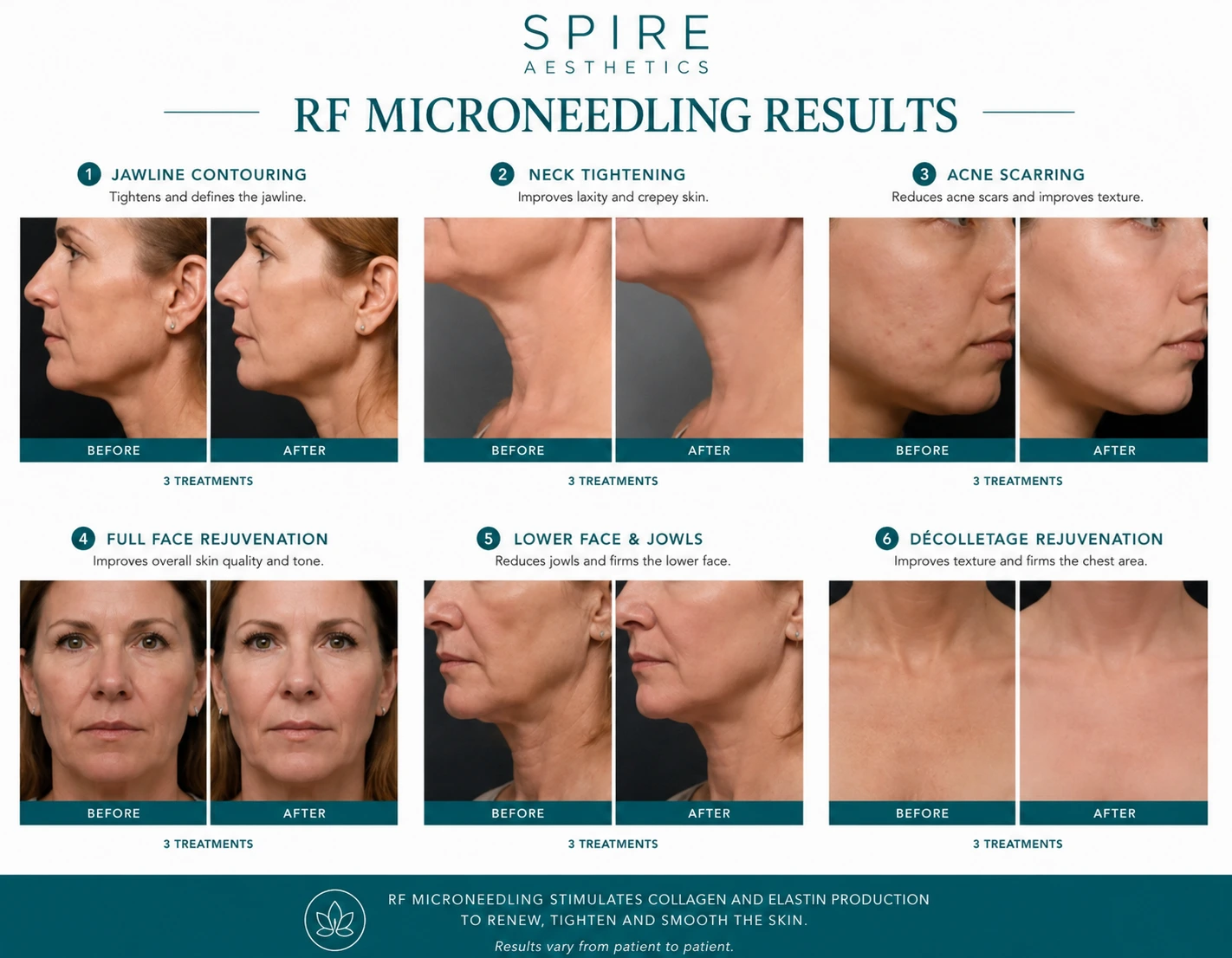RF Microneedling Skin tightening Rhyl results