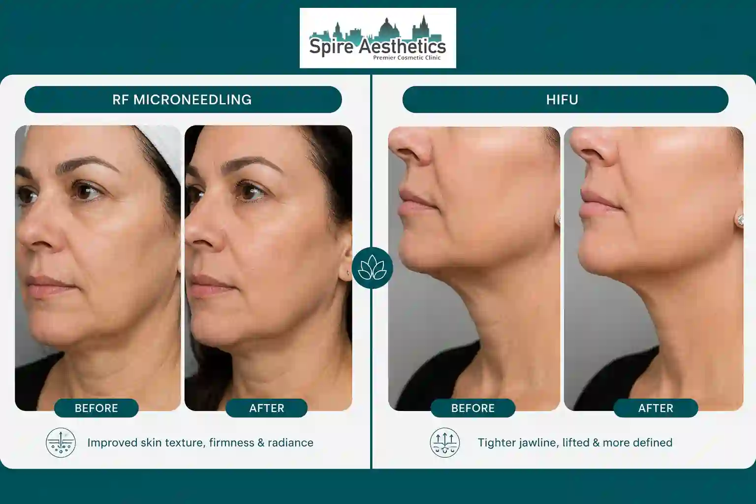 Can RF Microneedling and HIFU Be Combined Rhyl?