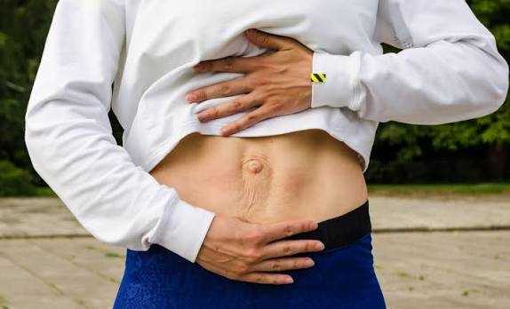When Could Diastasis Recti Be the Missing Piece of the Puzzle Rhyl?